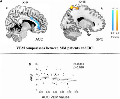 Brain structural and functional changes during menstrual migraine: Relationships with pain